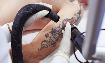 Услуги лазерного удаления татуажа